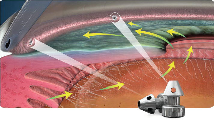 Chirurgie micro-invasive du glaucome (MIGS)